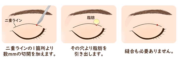 上眼瞼脱脂術、目の上の脂肪取り