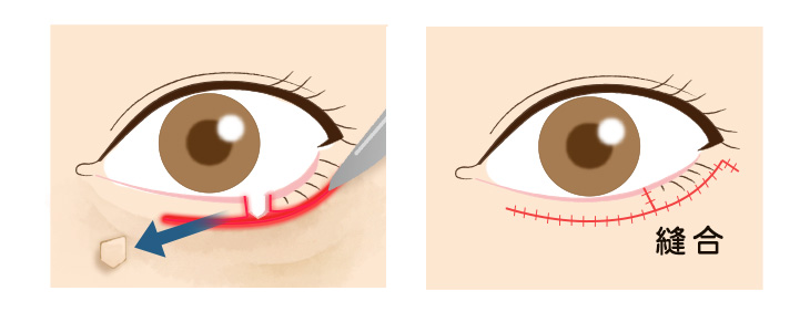 眼瞼外反症治療の説明の画像