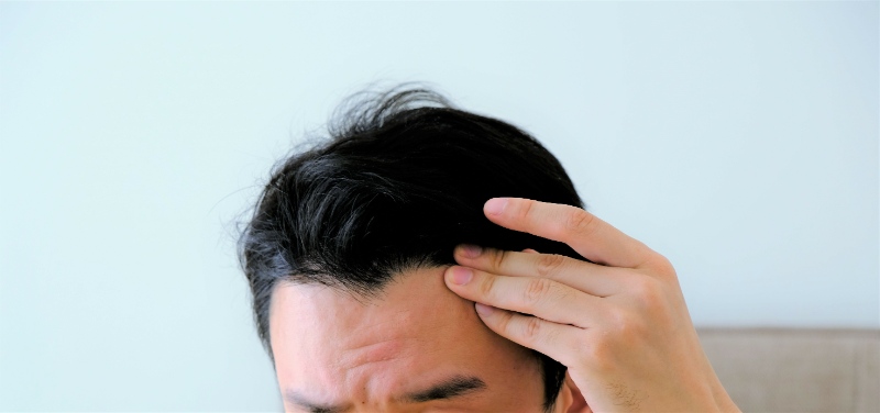 AGAは何歳から始まる？ 発症率と年齢の関係を徹底解説！