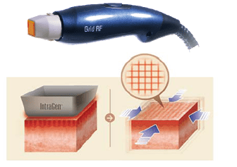 イントラジェン