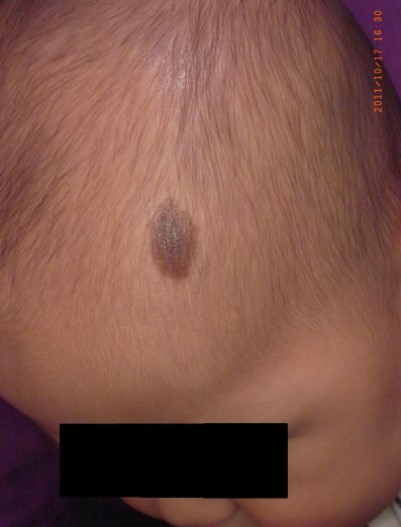 当院でのアザ治療写真(生後8か月、術前)