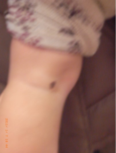 当院でのアザ治療写真(１歳、術前)