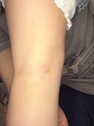 当院でのアザ治療写真(1歳、術後)