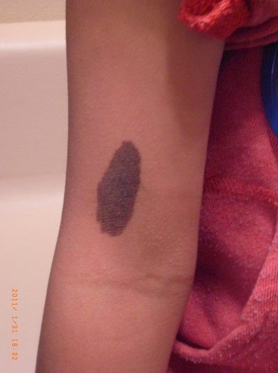 当院でのアザ治療写真(6歳、術前)