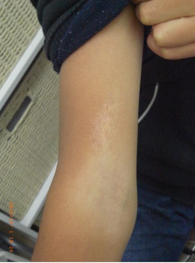 当院でのアザ治療写真(6歳、術後)