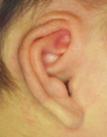 赤ちゃんの耳の形がおかしい 埋没耳の治療法 大西皮フ科形成外科 大津石山四条烏丸