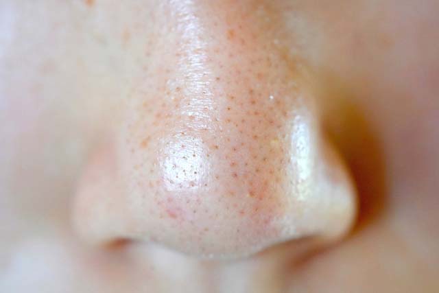治療 鼻 の 毛穴 皮膚科医に聞く！いちご鼻の黒ずみ毛穴を綺麗にする方法