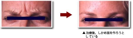 眉間 症例写真