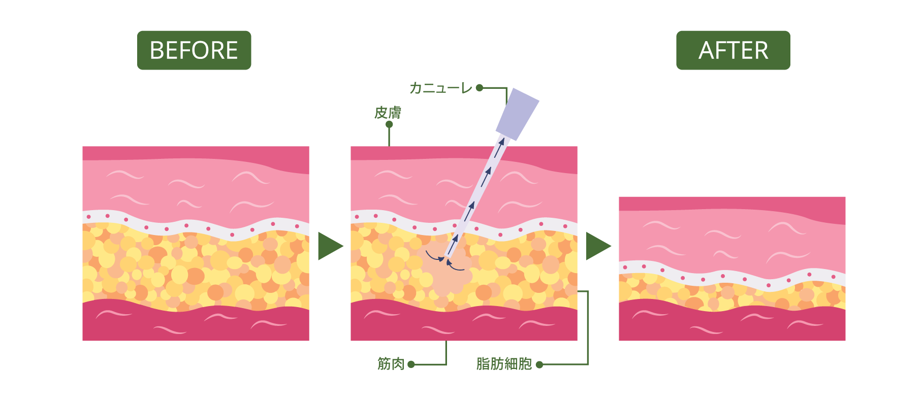 シリンジ法の図解