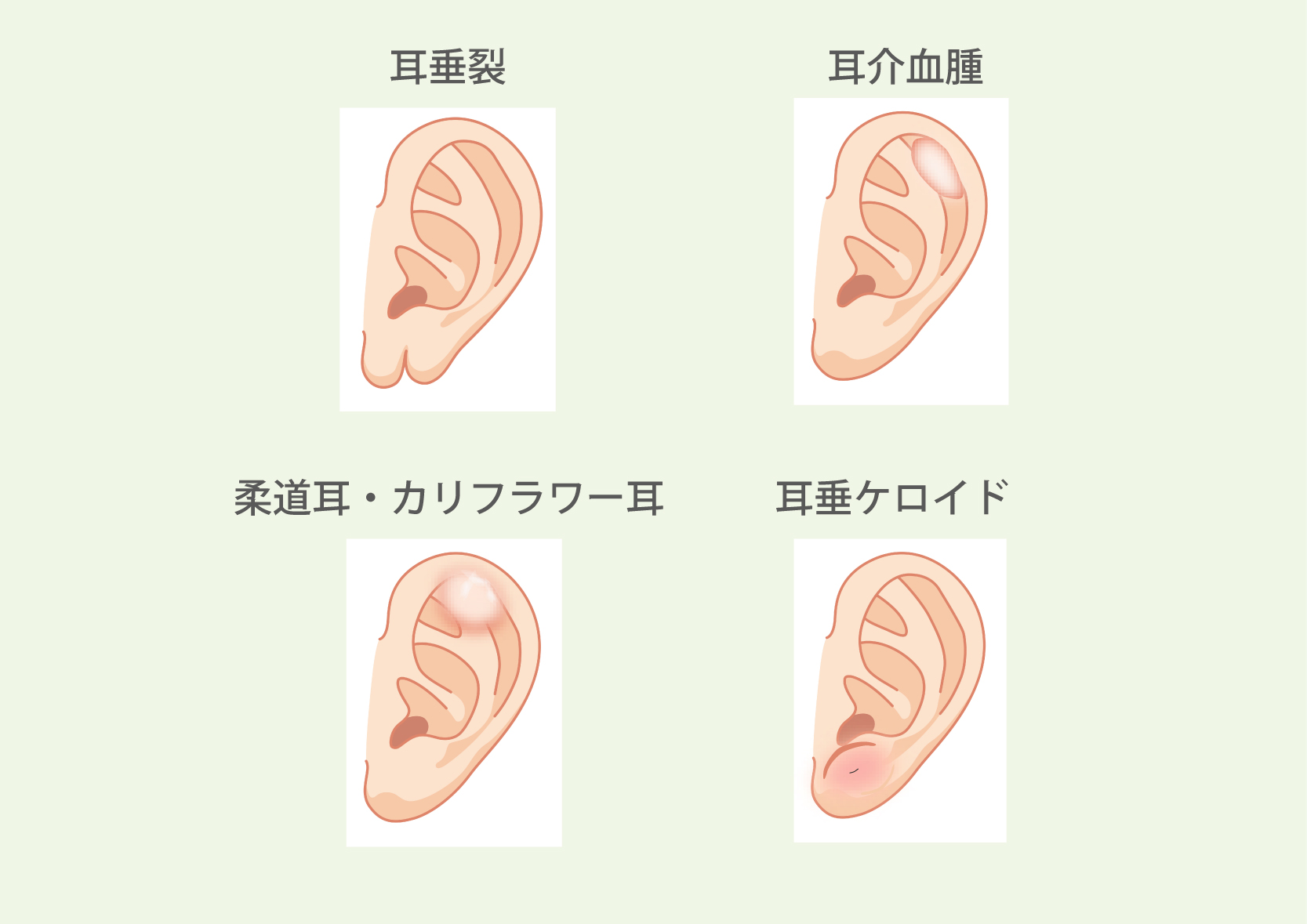 後天的耳介形成