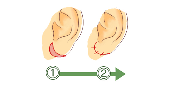 耳たぶ縮小術