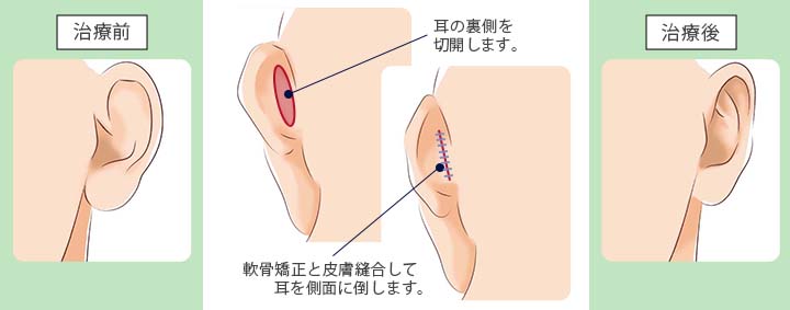 立ち耳の治療の流れ