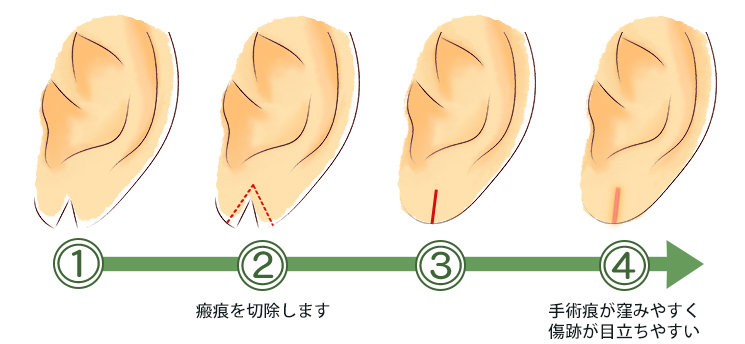 耳垂裂の治療の流れ_直線法