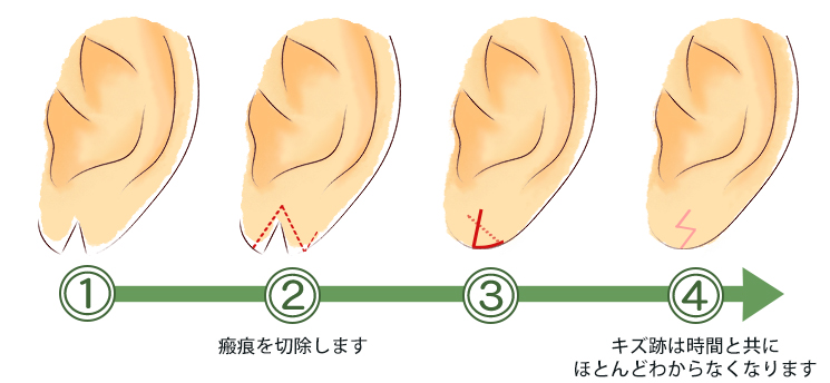 耳垂裂の治療の流れ_Z形成術