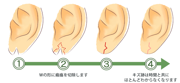 耳垂裂の治療の流れ_W形成術