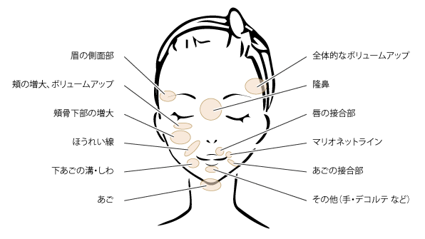 エランセの適用部位例