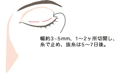 約3~5ミリ、1~2ヶ所切開し、糸で止め、抜糸は5~7日後