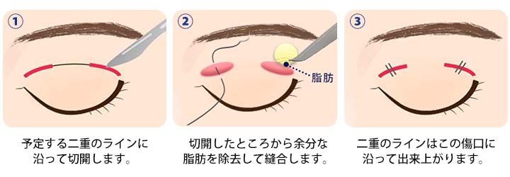 重瞼法(小切開法)