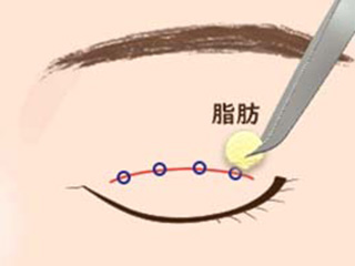 抜糸式重瞼法（ビーズ法）