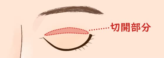 切開法の手術の流れ