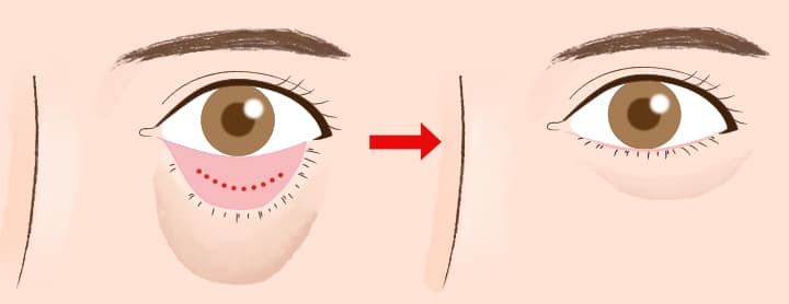 経結膜下脱脂術