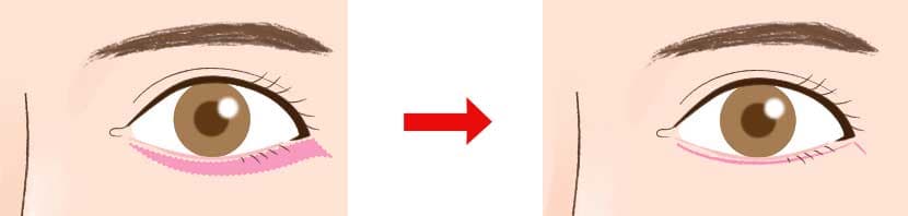 下眼瞼しわ取り手術