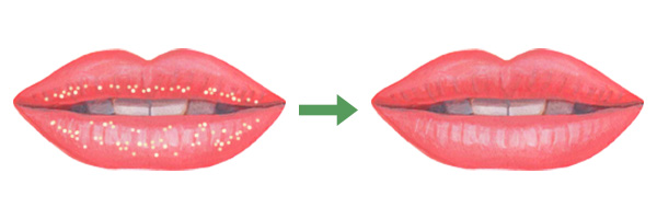 フォアダイス斑点はどのように治療されますか?