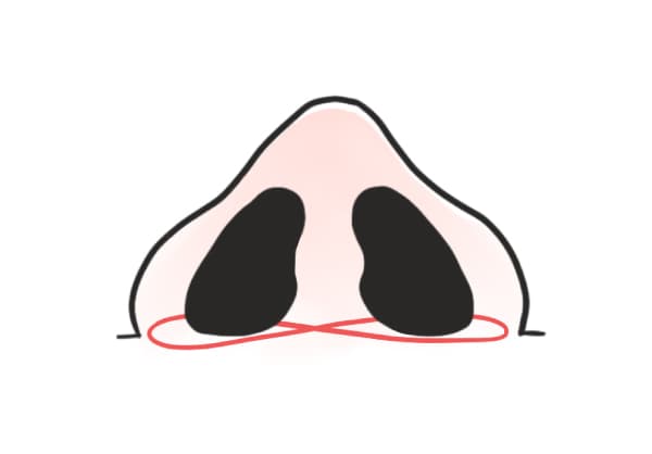 切らない小鼻縮小術