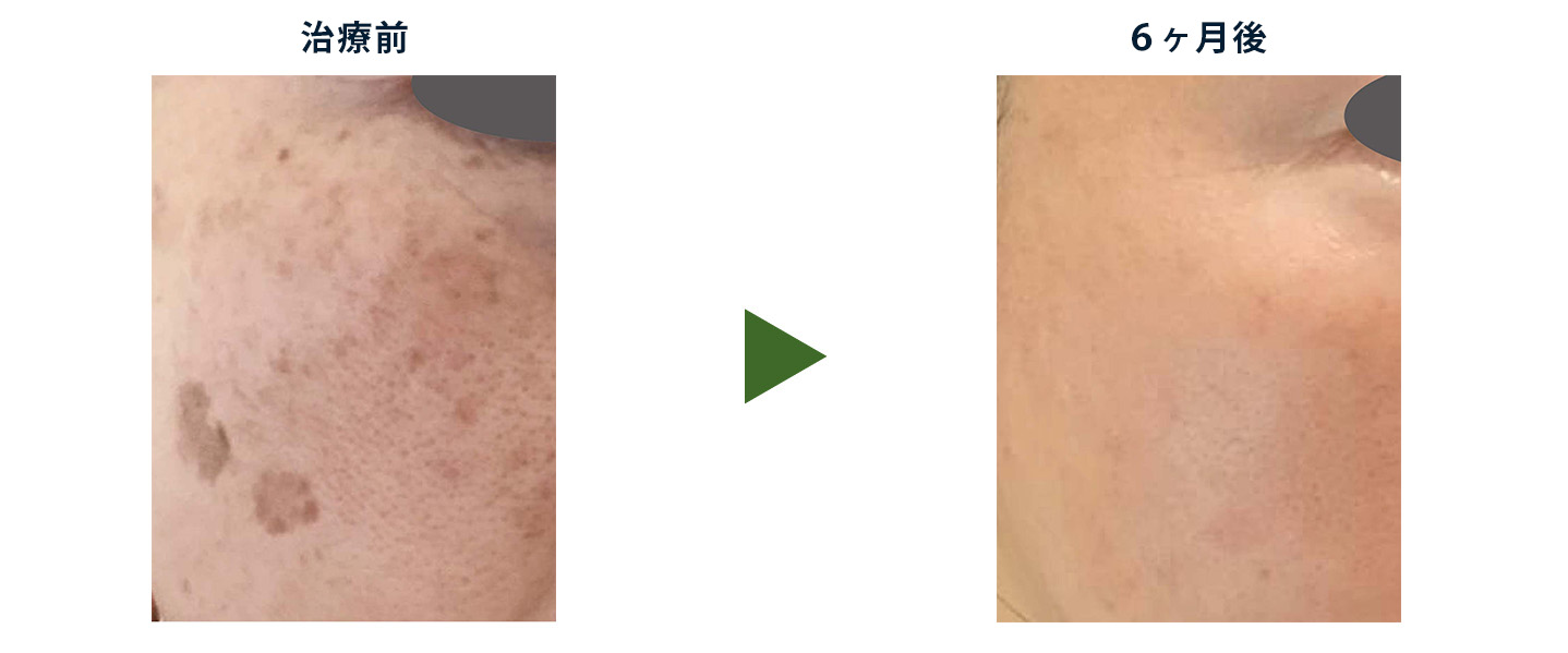 レーザー照射後と、その後のかさぶたの様子