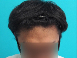 ドクターグロー服用後の写真