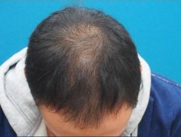 ドクターグロー服用前の写真