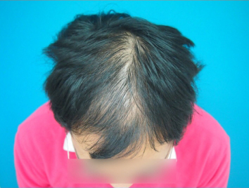 ドクターグロー服用前の写真