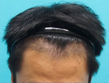 ドクターグロー服用後の写真