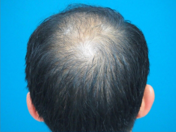 ドクターグロー服用前の写真