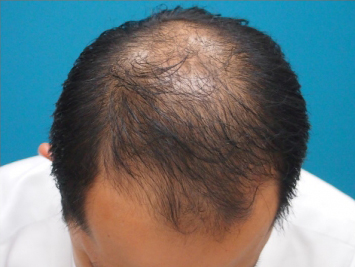 ドクターグロー服用前の写真