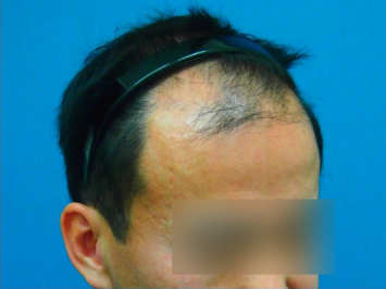 ドクターグロー服用前の写真