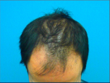 ドクターグロー服用前の写真