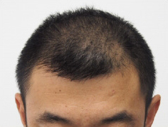 ドクターグロー服用前の写真