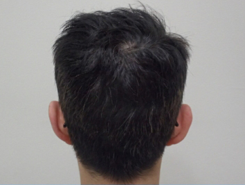 ドクターグロー服用後の写真