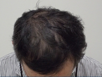 ドクターグロー服用前の写真