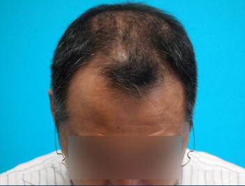 ドクターグロー服用後の写真