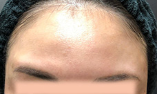 ボトックス後の写真