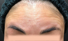 ボトックス前の写真