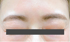 ボトックス後の写真