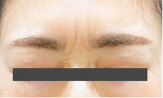 ボトックス前の写真