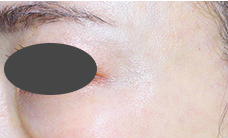 ボトックス後の写真