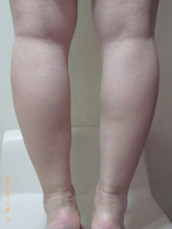 ボトックス後の写真