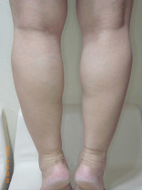 ボトックス前の写真