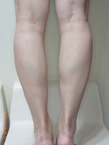 ボトックス前の写真