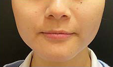 ボトックス治療後の写真